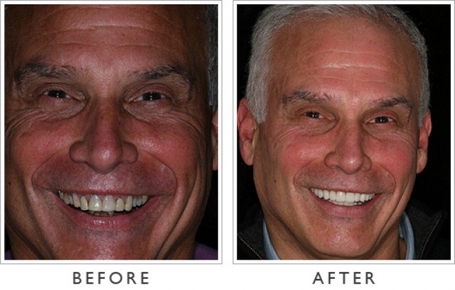 Before After Pictures Of Veneers 92